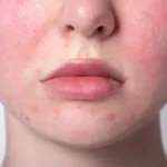 Skin Doctor in Baripada