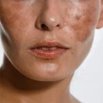 How to Decrease Melanin in Skin